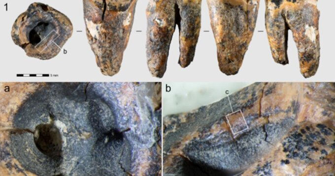 Ząb trzonowy neandertalczyka z&nbsp;widocznym wywierconym ubytkiem