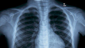 Rak płuca: co musi się zmienić?