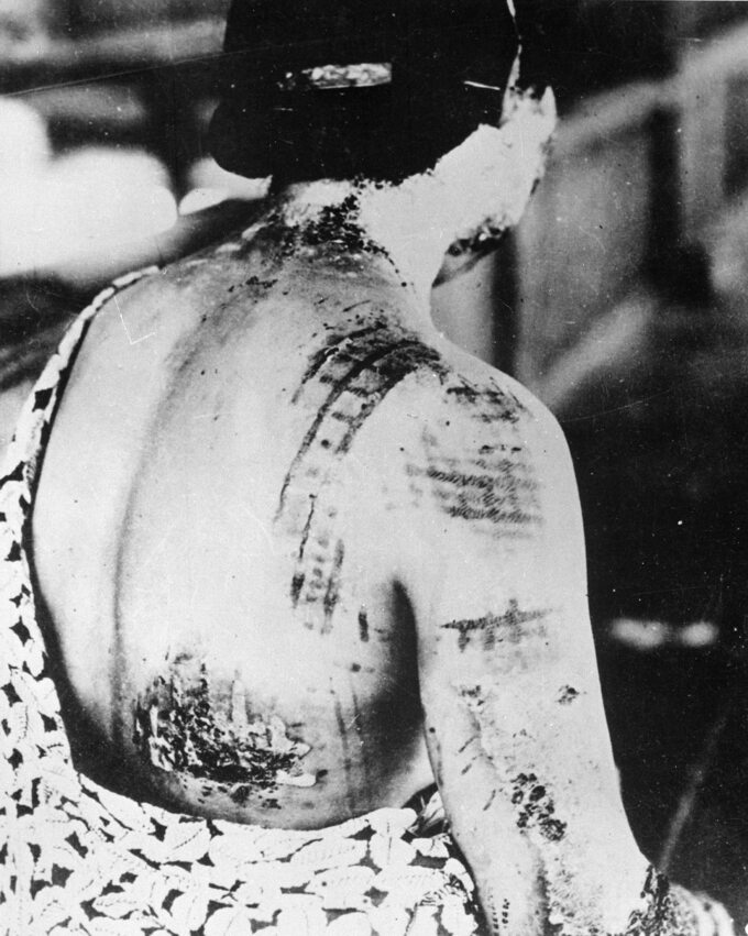 Oparzenia z wzorami ubrania, które miała na sobie kobieta w momencie eksplozji bomby atomowej