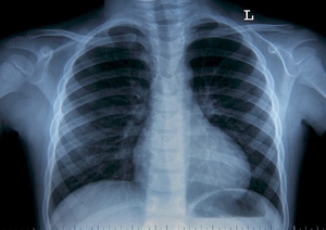 Nowe odkrycie. Dlaczego COVID-19 uszkadza płuca?