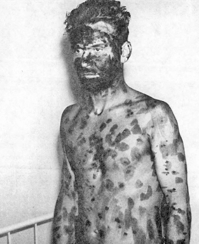 Chory z wysypką ospową pokrytą środkiem do dezynfekcji ran (Wrocław, 1963)