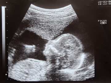 Ciąża, zdjęcie ilustracyjne