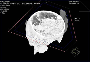 Prześwietlenie czaszki z Heslington. Ciemniejszy obszar w jej wnętrzu to skurczony mózg