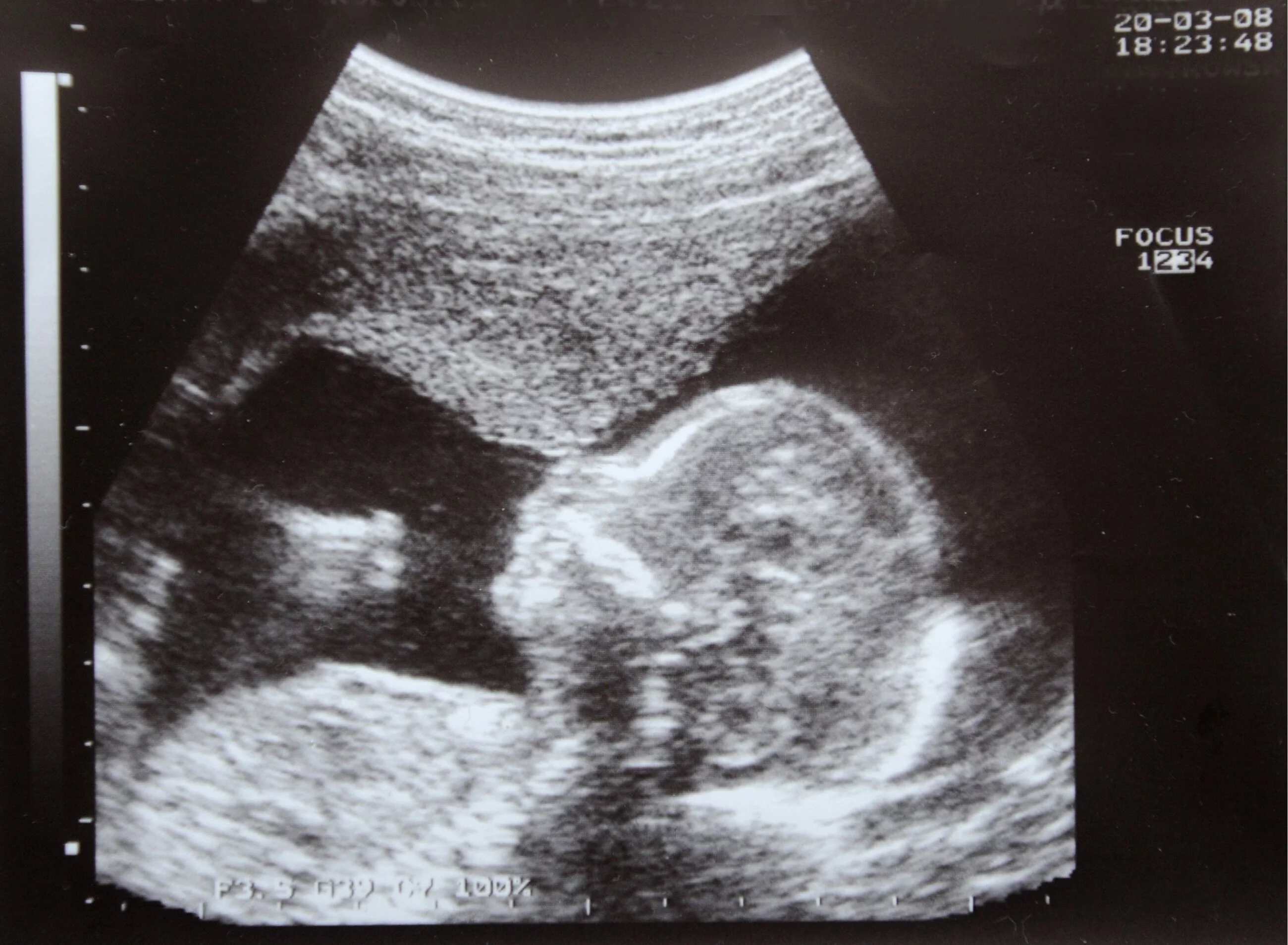 Tyle aborcji wykonano w tym roku. Nowe dane NFZ