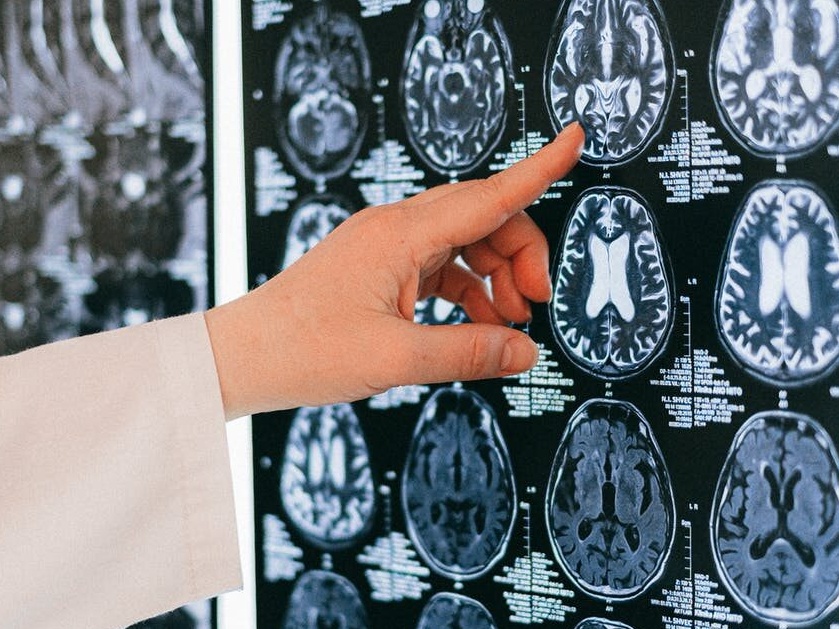 Mózg, zdjęcie ilustracyjne